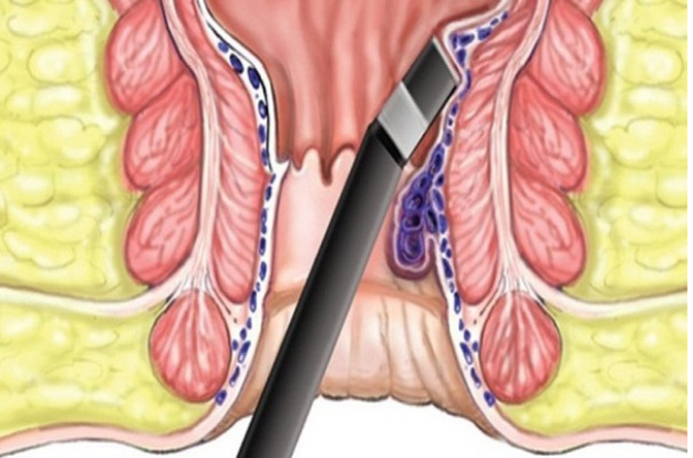 Perianal Fistül Lazer