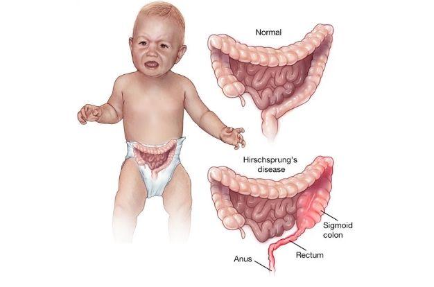 Hirschsprung 
