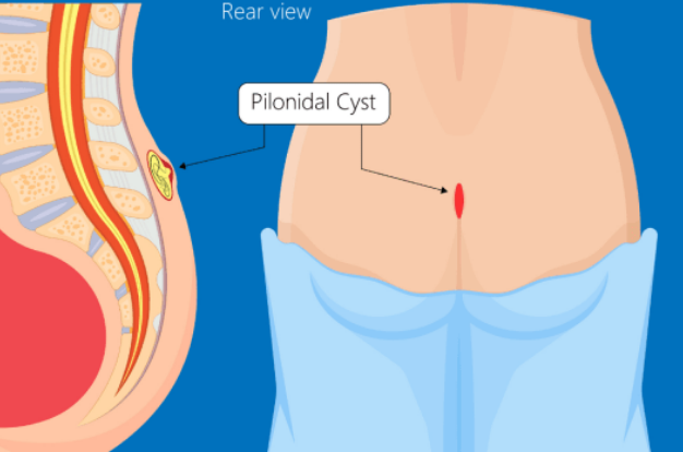 Pilonidal Sinus