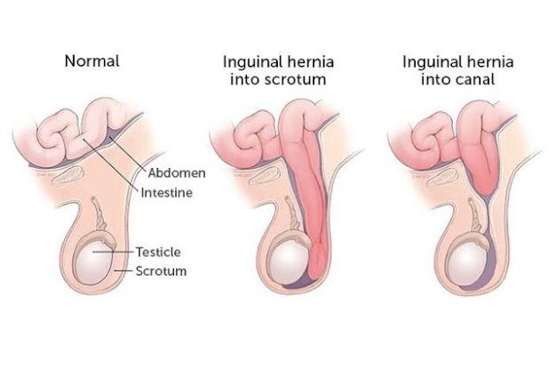 İnguinal Herni, Hidrosel